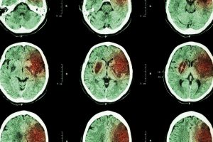 Ataque Cerebral Viral: Manifestações Neurológicas do COVID-19