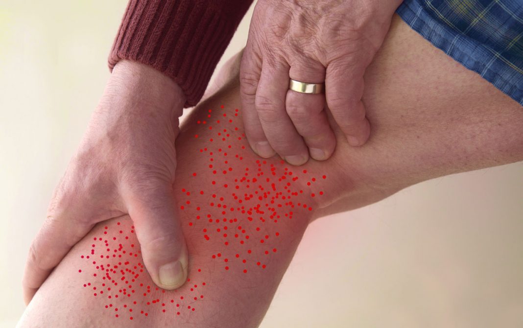 Entorpecimento ou formigamento